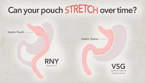 Gastric sleeve surgery involves reducing the size of your stomach so you feel full after eating only a small amount of food. Will The Stomach Stretch After Bariatric Surgery Mccarty Weight Loss