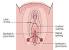 Cyst On Outer Labia