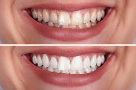 Teeth whitening + after braces q&a. Teeth Whitening At Home Ava Orthodontics Invisalign