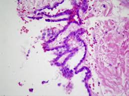 Identification of neoplastic invasion is definitive criteria for diagnosis of malignant mesothelioma · finding of mesothelial cells in fat makes . Benign And Malignant Mesothelial Proliferation Surgical Pathology Clinics
