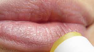 Por Que Me Salen Pequenos Puntos Blancos En Los Labios