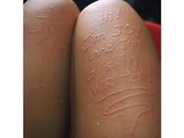 Image result for Dermatographism