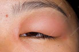 Swollen Eyelid After Insect Bite Stock Image C009 0041 Science Photo Library