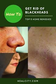 How To Get Rid Of Blackheads Top 5 Home Remedies Skin Care Remedies Get Rid Of Blackheads Skin Remedies