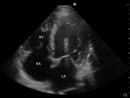 ▪ герпес вирус 6 типа. Evaluation Of Left Ventricular Function By Bedside Ultrasound In Acute Toxic Myocarditis Sciencedirect