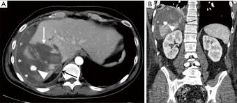 Modern multidetector ct allows rapid adrenal imaging with high spatial resolution, facilitating evaluation of fine contour features. Multi Detector Computed Tomography In The Diagnosis And Characterization Of Adrenal Gland Traumatic Injuries Abstract Europe Pmc