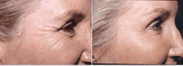 En este artículo dedicares el contenido a demostrarte como son los resultados del botox en los rostros de los famosos que han utilizado el botox para. Tratamiento Arrugas Cara Botox New Metica Clinica De Medicina Estetica
