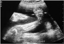 About 10 percent of clubfeet can be diagnosed as early as 13 weeks into pregnancy. Kjr Korean Journal Of Radiology