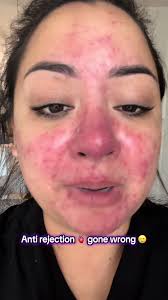 My Rosacea is flaring 😭 #rosacea #rhynophyma #antirejection #normapalacios