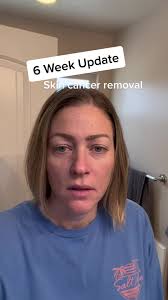 6 Week Update After MOHS Surgery: Healing Progress & Laser Treatments