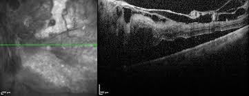 Chan ck, meyer ch, gross jg, abraham p, nuthi as, kokame gt et al. Retinal Traction Detachment Article