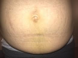 Bruised Belly After C Section Babycenter