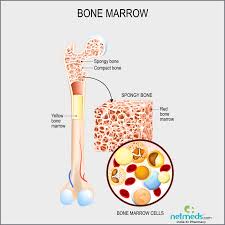 Acute myeloid leukemia (aml) starts in the bone marrow (the soft inner part of certain bones, where new blood cells are made), but most often it quickly moves into the blood, as well. Bone Cancer Causes Symptoms And Treatment Netmeds