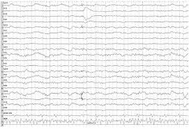 Eeg In Focal Encephalopathies Cerebrovascular Disease Neoplasms And Infections Thoracic Key