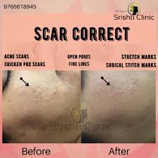 It spreads through coughs and sneezes. Do Chicken Pox Scars Stay Forever