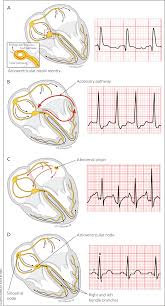 Common Types Of Supraventricular Tachycardia Diagnosis And