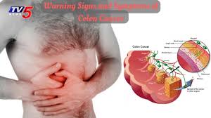 Its actual cause is not known, but risk factors include increasing age. Causes Symptoms And Treatment For Colorectal Cancer Health File Tv5 News Youtube