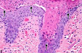It isn't always a clot or cold that leads to. Skin Necrosis Nonneoplastic Lesion Atlas