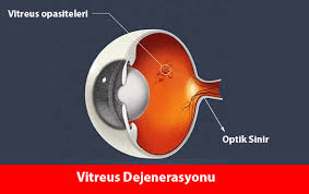 Vitreus Dejenerasyonu Doc Dr Fatih C Gundogan Kayseri