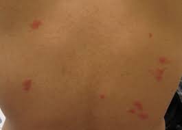 „nauki ich być nie powinno. Co Mnie Ugryzlo Najczestsze Ugryzienia Owadow I Ich Zdjecia