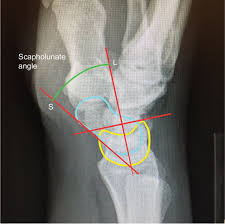 Image result for Scapholunate Dislocation