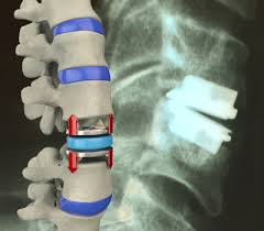 Maybe you would like to learn more about one of these? Cervical Disc Herniation Atlantic Spine Specialists Morristown Nj