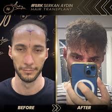 Let your new hair change more than just your look change your vibe! 🌟 With  Serkan Aydın Hair Transplant, achieve fuller, stronger hair and boost your  confidence to new heights. Rediscover yourself!