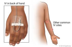 Image result for Difficult Intravenous Access in Children