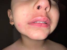 Does skin virus drops help with yeast rashes