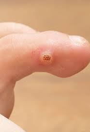 More common in dark skin, keloids can form anywhere, but. Warts Arizona Desert Dermatology And Surgery