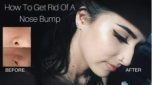How To Get Rid A Nose Bump In One Week Update Youtube Nose Piercing Bump Piercing Bump Nose