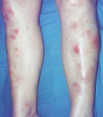Image result for erythema nodosum