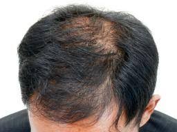 For example, if you have bald patches. Seven Natural Ways To Get Thicker Hair