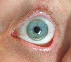 Sight Eyecare An Eye Exam Might Be The First Indicator Of High Cholesterol