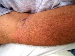 A normal human platelet count ranges from 150,000 to 450,000 platelets per microliter of blood. Trombocitopenia