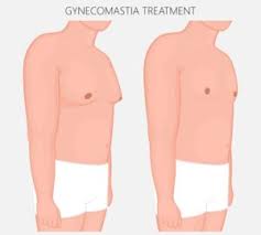 How to know if you have gyno. How Do I Know If I Need Gynecomastia Surgery