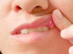 Mouth injuries such as cuts, burns, and irritation can also cause the formation of bumps on the roof of your mouth. Bump On The Roof Of The Mouth 12 Causes