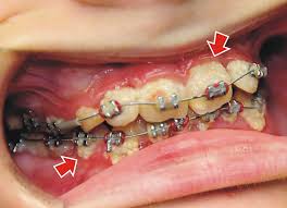 You can only reduce the amount of bacteria in your mouth. How Do You Treat White Spots After Braces Ask An Orthodontist Com