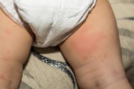 Image result for sore skin in the groin area