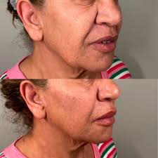 Weightloss affects patients in different ways and facial changes is common.  sometimes your face can start to change as your aging as well, and not  simply from weight loss. If you feel