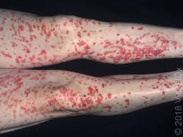 Petechiae are pinpoint, round spots that appear on the skin as a result of bleeding. Image Iq A 43 Year Old Man With A Symmetrical Palpable Purpura Rash On His Legs
