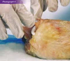 Image result for Bartholin's gland abscess