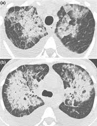 Image result for Pulmonary Intoxicant