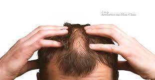 Because candida thrives in warm, moist environments, cutaneous candidiasis often develops in the folds of the skin (like elbows, behind the knees and under the breast tissue) and can cause the following symptoms: Are Fungal Infections Responsible For Hair Loss