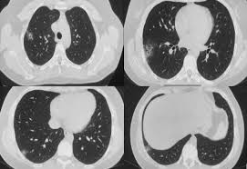 Chest ct scan which was done on the next day demonstrated heterogenic fluid in the right pleural cavity as well as in the pericardial cavity. Resection Of Pulmonary Endometriosis By Video Assisted Thoracoscopic Surgery Using Bronchoscopy As A Preoperative Strategy The Annals Of Thoracic Surgery