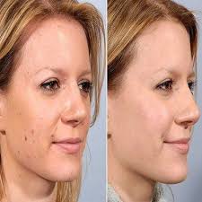 Normally your doctor will do it in their office, clinic, or a hospital outpatient center. Best Mole Removal In Dubai Abu Dhabi Mole Treatment Clinic Cost