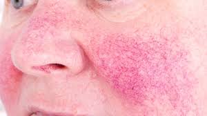 We did not find results for: 10 Facts About Rosacea Mental Floss