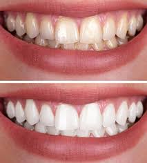 If you have teeth that are sensitive to teeth whitening but still want to achieve a whiter, brighter smile, try crest 3d white gentle routine whitestrips. Zoom Teeth Whitening In Horseshoe Bay Yellow Teeth Dr Sopel