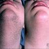 Laserall is colorado's premier laser hair & tattoo removal provider. 3