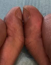 Image result for Clubbing nails feet